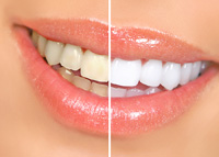 Teeth Whitening | Pediatric Dentist in Cumberland, RI | Dental Associates of Cumberland
